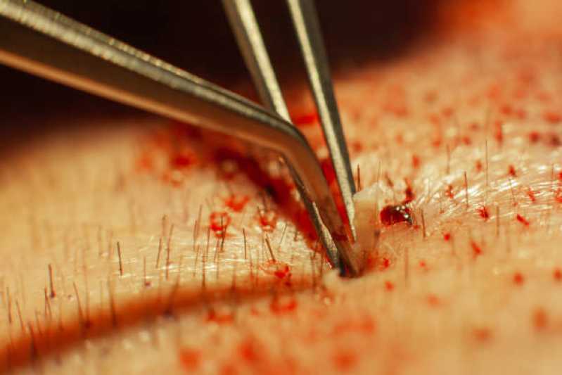 Preço de Cirurgia de Transplante de Cabelo para Homens Itaberai - Cirurgia de Transplante de Cabelo Liso