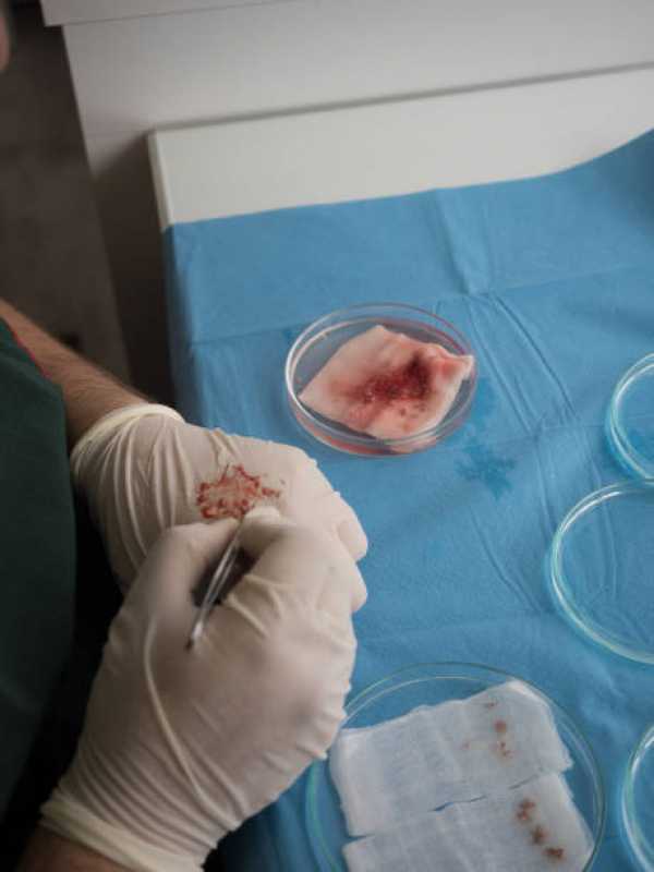 Preço de Cirurgia de Transplante de Cabelo Pindamonhangaba - Cirurgia de Transplante de Cabelo para Mulheres