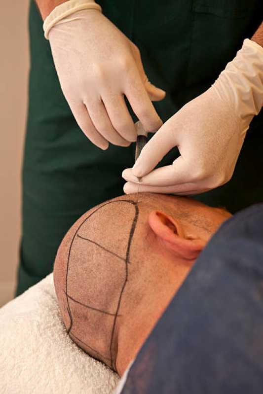 Preço de Implante de Cabelo para Homens Belém - Implante de Cabelo Masculino