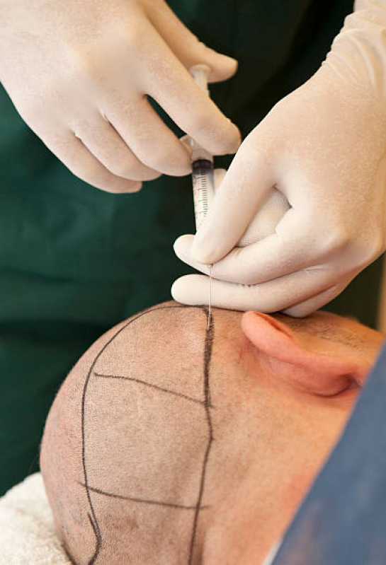 Preenchimento Capilar na Testa Goianápolis - Preenchimento Capilar para Homens