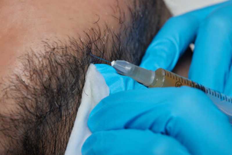 Quanto Custa Transplante Capilar para Barba Cachoeira Paulista - Transplante de Barba Rala