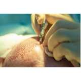 Cirurgia de Transplante Cabelo Feminino