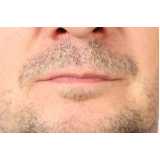 clínica de implante barba Saúde