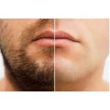 clínica de implante capilar na barba Lins