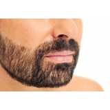 clínica de implante capilar para barba telefone Franco da Rocha