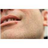 clínica de implante capilar para barba GRANJA VIANA