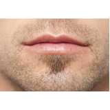 Clínica de Implante Capilar Barba
