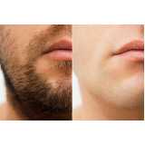 Clínica de Implante Capilar de Barba