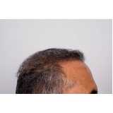 clínica especializada em cirurgia implante para cabelo Itaim Bibi