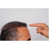 clínica especializada em implante cabelo masculino Recanto das Emas