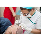 clínica que faz implante de cabelo Marabá