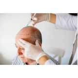contato de clínica de tratamento para queda de cabelo Zona Leste