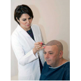 contato de clínica implante de cabelo Monte Alto
