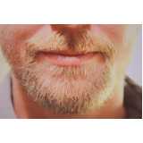 endereço de clínica de implante capilar para barba rala Santarém