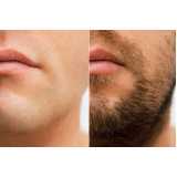 endereço de clínica de implante para barba rala Ouvidor