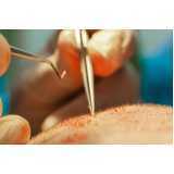 endereço de clínica para implante capilar Parauapebas
