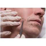 implante bigode clínica Taboão da Serra