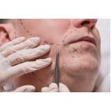 implante bigode preços Varjão