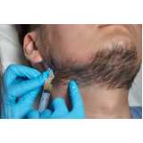 implante capilar de barba Varjão