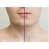 implante capilar para barba Belém