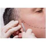 implante de barba rala Abadiânia