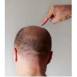 implante de cabelo masculino Rio Quente