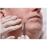 implante na barba clínica Caraguatatuba