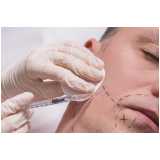 implante para barba clínica Carapicuíba