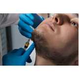 onde fazer implante capilar para barba Ibirapuera