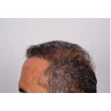 preço de implante cabelo masculino Marabá