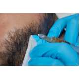 quanto custa transplante capilar para barba Itaim Bibi
