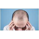 transplante de cabelo masculino preço Mairipotaba