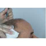 transplante de cabelo para homens Itumbiara