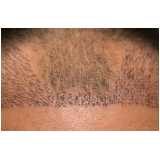 tratamento para queda de cabelo masculino Tatuapé