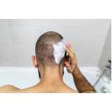tratamento queda de cabelo masculino Itumbiara