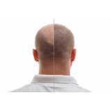 valor de transplante de cabelo para homens Campo Grande
