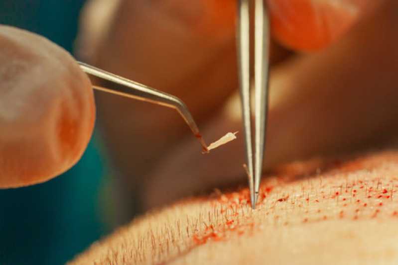 Transplante Cabelo Preço Tatuapé - Transplante de Cabelo para Mulheres