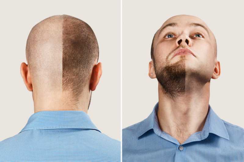 Transplante Capilar na Barba Valores Araguaína - Transplante Capilar para Barba