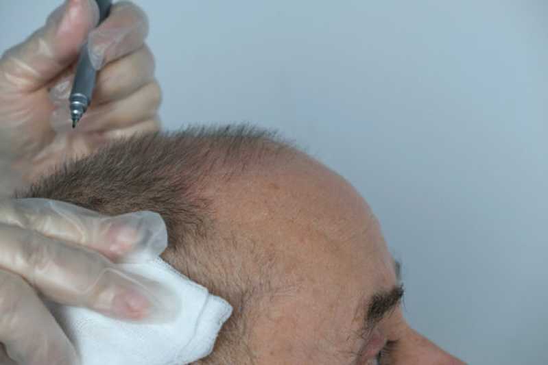 Transplante de Cabelo para Homens Vila Mariana - Transplante de Cabelo Liso