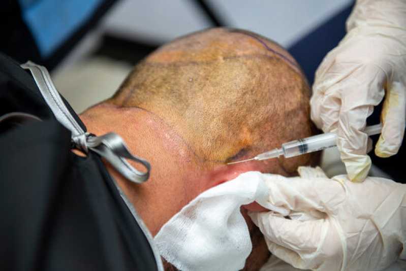 Tratamento Calvície Ibirapuera - Tratamento de Calvície Masculina
