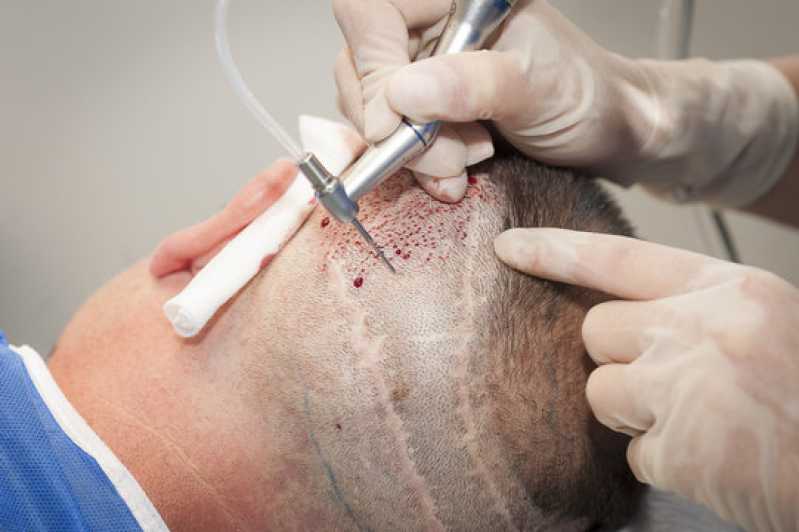 Tratamento de Intradermoterapia Itapoã - Tratamento Capilar para Queda de Cabelo