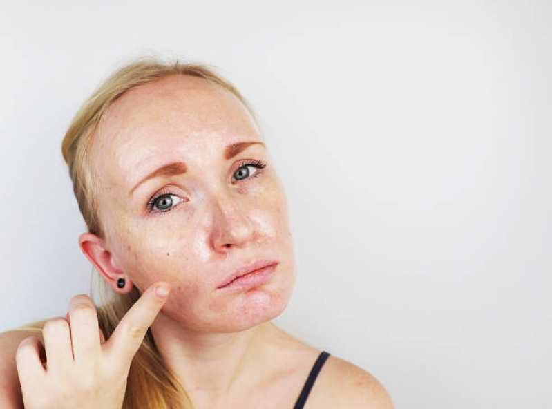 Tratamento de Peeling Facial São Gabriel. - Tratamento de Rejuvenescimento Facial