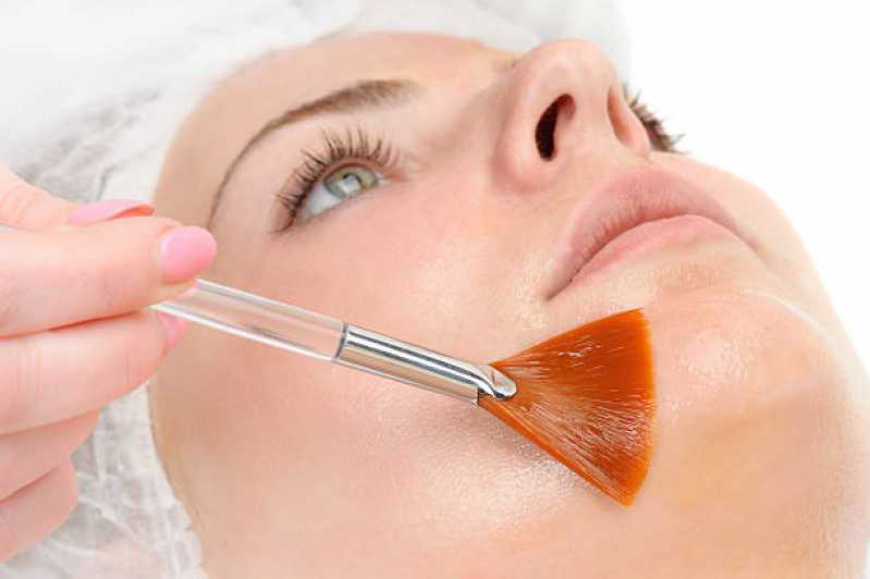 Tratamento de Peeling para Estrias Preço Salesópolis - Tratamento de Peeling para Cicatriz de Acne