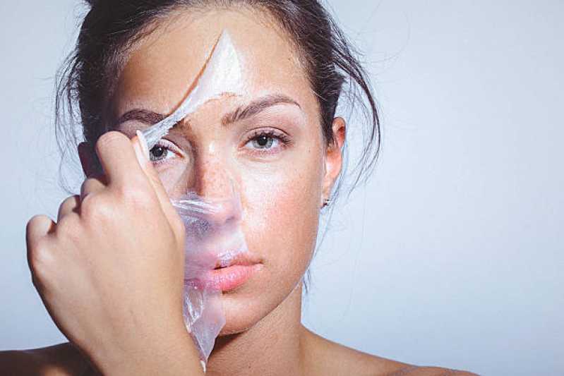 Tratamento de Peeling Químico para Melasma Preço Sobradinho - Tratamento de Peeling para Cicatriz de Acne