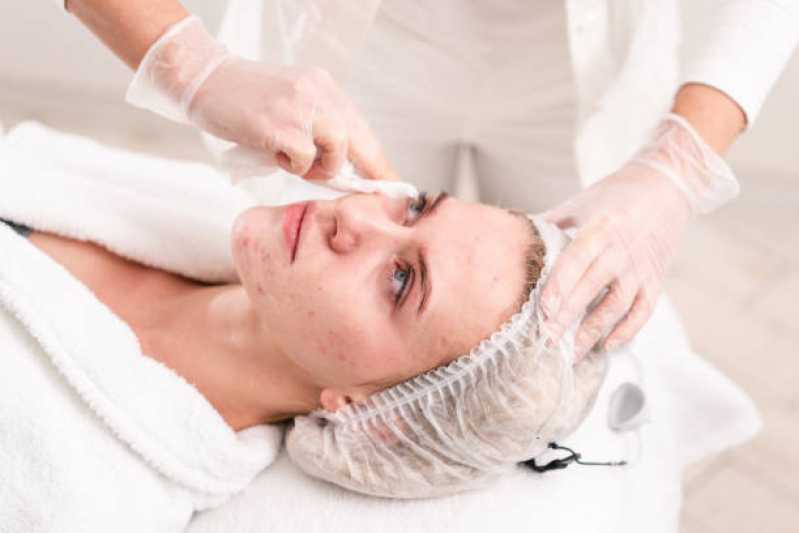 Tratamento de Preenchimento Facial Carapicuíba - Tratamento com Limpeza de Pele Masculina
