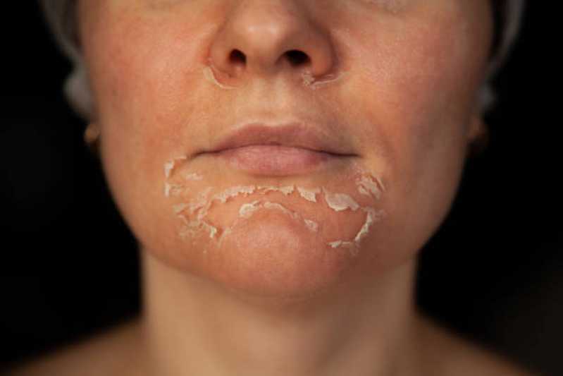 Tratamento Facial Clínica Goiatuba - Tratamento com Limpeza de Pele Masculina