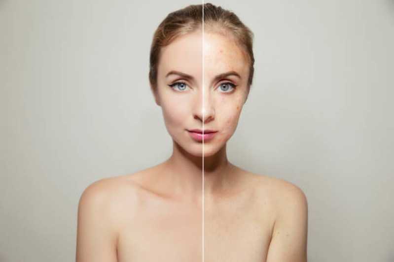 Tratamento Flacidez Rosto Recanto das Emas - Tratamento Facial