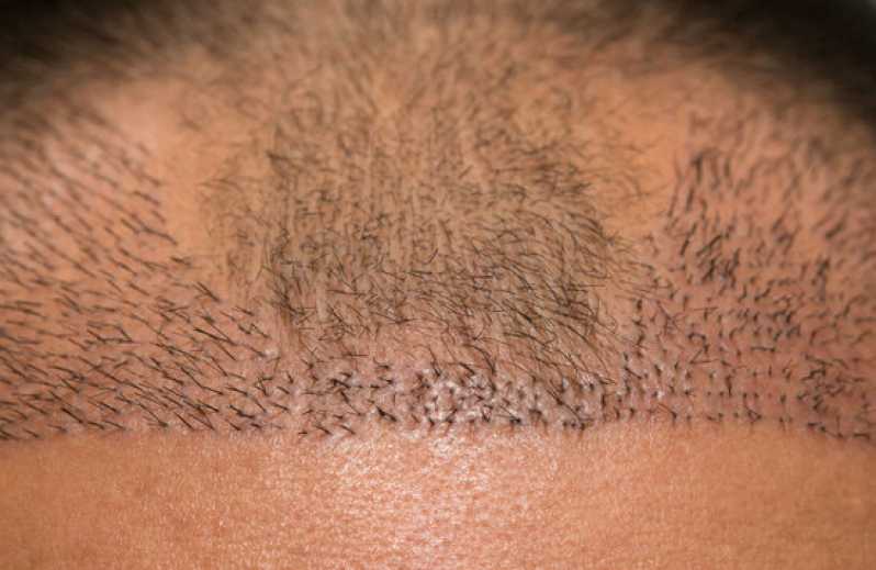 Tratamento para Queda de Cabelo Masculino Goianápolis - Tratamento para Queda de Cabelo Masculino