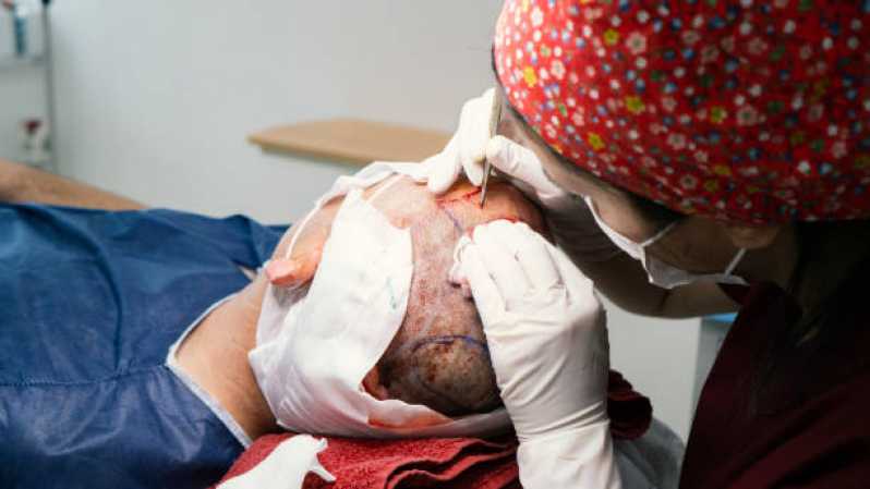 Valor de Implante Capilar Masculino Salesópolis - Implante Capilar para Mulheres