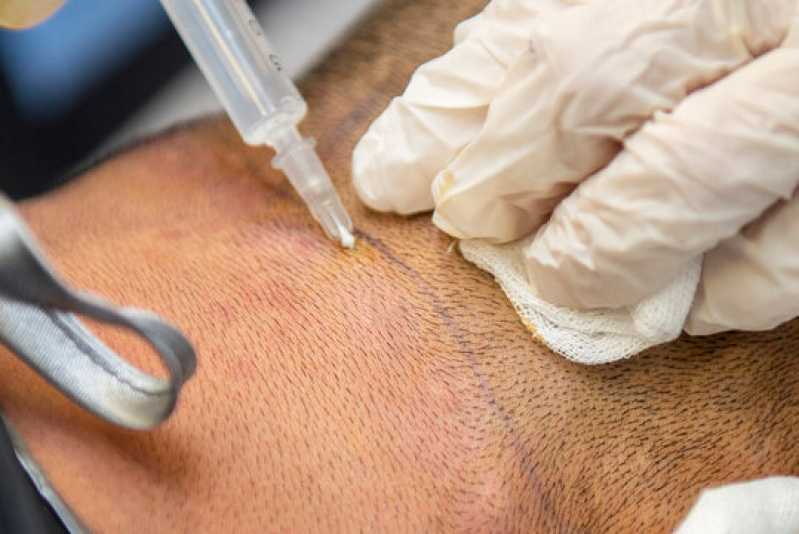 Valor de Tratamento com Microagulhamento para Calvície Taguatinga Norte - Tratamento Led Terapia Capilar